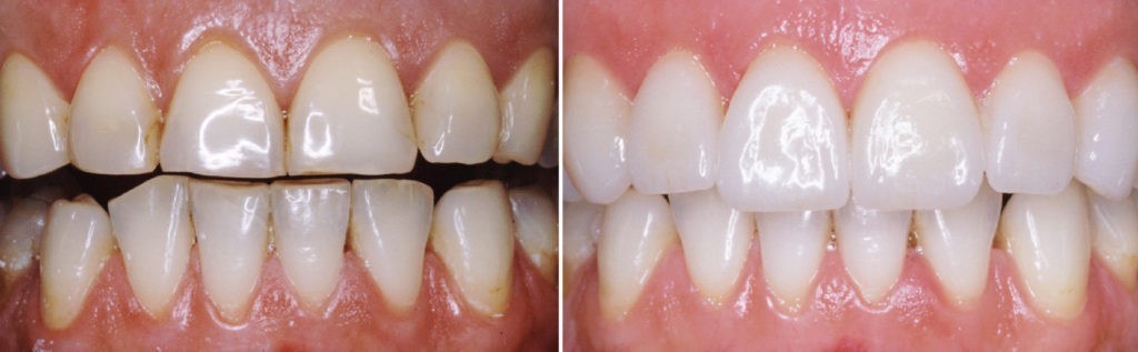 Veneers Bremen – Vorher-Nachher-vergleich