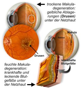 Makuladegeneration, Grafik zur Entsehen von Drusen, Abbauprodukten aus dem Seh-Stoffwechsel.