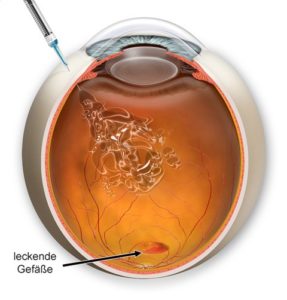  Grafik der intravitrealen Medikamenteninjektion bei Makuladegeneration. Ein Medikament wird ins Auge gespritzt.