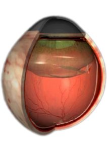 Netzhautabloesung Bremen: Grafik zeigt, wie der schrumpfende Glaskörper an der Netzhaut zieht und ein Loch reißt