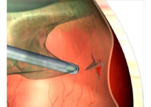 Netzhautabloesung Bremen: Grafik der Glaskörperchirurgie. Der Glaskörper wird entfernt und der Zug auf die Netzhaut entlastet.